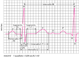 L infarct miocardic acut l reumatismul articular acut l tuberculosa l colagenozele l trauma toracelui l neoplazmele (primare sau frecvent. Elettrocardiografia Disturbi Dell Apparato Cardiovascolare Manuali Msd Edizione Professionisti