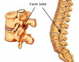 It is when you develop neck pain and stiffness with spasm of the surrounding neck. Facet Joint Chiropractic Treatment Milton Keynes Northampton Aylesbury