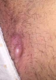 Meine ärztin hat schon angedeutet das sie mich an die uniklinik weiter. Kleine Pickelartige Beulen An Der Grenze Zwischen Intimbereich Und Oberschenkel Was Konnte Das Sein Gesundheit Arzt Hautprobleme