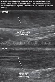 Achilles tendon injuries can be debilitating. Achilles Tendinopathy And Achilles Tendon Partial And Full Thickness Rupture Caring Medical Florida