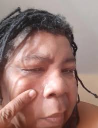 Sister Locs and Psoriasis