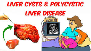 Liver Cysts And Polycystic Liver Disease Youtube