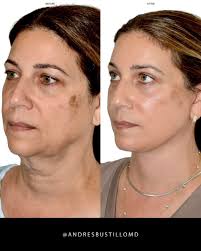 Andres Bustillo, MD, FACS