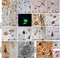 Check spelling or type a new query. Frontal Lobe Epilepsy With Focal Neuronal Lipofuscinosis Fnl Case E1 Download Scientific Diagram