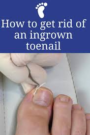 Pin On Ingrown Toe Nail Remedies