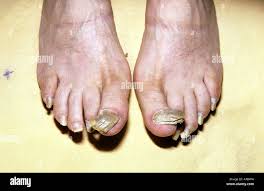 Image result for Onychogryphosis feet