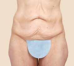 The most likely way to get the surgery. Tummy Tuck Plastic Surgery Cleveland Clinic