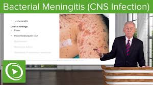 Meningitis is a serious infection of the meninges in the brain or spinal cord that is most commonly viral or bacterial in origin, although fungal, parasitic, and noninfectious causes are also possi. Bacterial Meningitis Cns Infection Infectious Diseases Lecturio Youtube