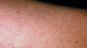 Hives, also called urticaria, are red, itchy, raised bumps or welts on the skin. Causes Of Red Bumps And Spots On Legs