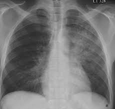 Imagens Da Doenca Pulmonar Gerald W Staton Jr E Sanjeev Bhalla Medicinanet