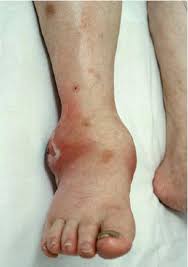 نتیجه تصویری برای ‪infectious arthritis‬‏