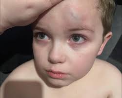 My child a few years back my son decided within the space of 6 months to  cut his head open twice