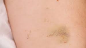 Insan Isirigi Tedavisi Hemen Saglik