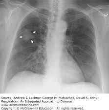 Image result for lung cancer xray