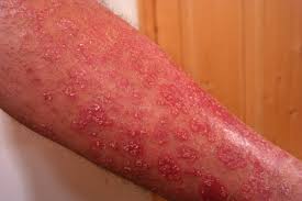 Image result for Pustular Psoriasis