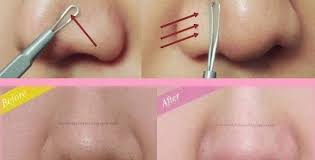 Getting Rid Of Stubborn Acne On Nose How To Take Out Acne Foods That Cause Acne In Adults Acne On Nose Nose Pimples Cystic Acne