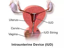 Missing or lost iud strings are known as nonvisualized strings. What Would You Do If Iud Got Pushed During Sex Quora