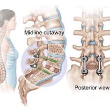Revision Spine Surgery Second Opinion Spine Spinal Fusion Spinal Fusion Surgery Spine Surgery