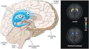 This is the newest place to search, delivering top results from across the web. The Neglected Side Of Parkinson S Disease American Scientist