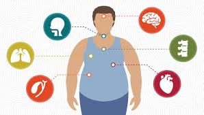 Image result for Obesity