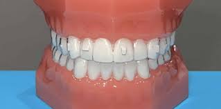 Why Some Teeth Do and Don't Have Attachments Escondido CA