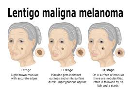 It is also known as simple lentigo. Lentigo Maligna And Lentigo Maligna Melanoma Causes Symptoms And Treatment