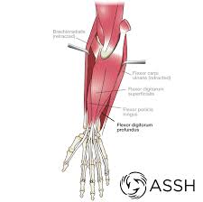 The brachioradialis muscle, which is fixed to the radius, to its distal end. Body Anatomy Upper Extremity Tendons The Hand Society