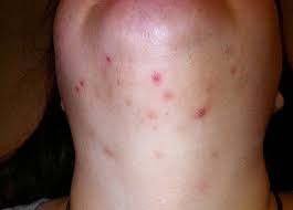 Ingrown hair scars, like all scars, form as part of the natural healing process. Pin On Just For Me