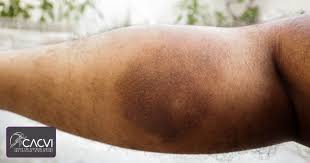 Image result for Pigment stains on the shin