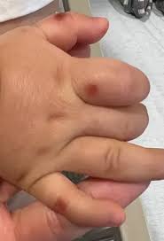 Image result for Hand foot and mouth disease HFMD roof of mouth