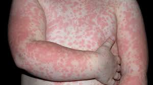 Image result for medicine for skin disease