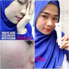 Serum ini mengandungi peptide untuk merangsang. Bebas Jerawat Dalam Dua Minggu Eucerin Proacne Solution A I Clearing Treatment Cerita Budak Sepet