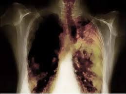 Pin Di Lungs