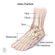 Image result for Metatarsal