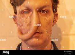 Skin graft hi-res stock photography and images