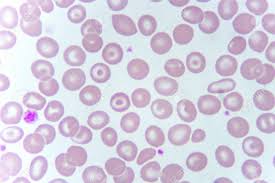 I'm just trying to figure out if there is a way to change the target cell to run the same code. Target Cells With Abnormal Red Blood Cells From Anemia Patient Stock Photo Picture And Royalty Free Image Image 105101897