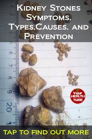 Kidney Stones Symptoms Types Causes And Prevention Your Health Tube Kidney Stones Symptoms Nutritional Therapy Health
