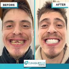 Transform Your Smile with Zirconium Crowns and Expert Care