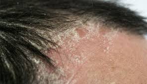 Image result for white scabs on the head in children