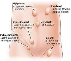 Hernia Repair - Highgate Private Hospital