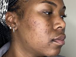 Difference Between Acne and Purging