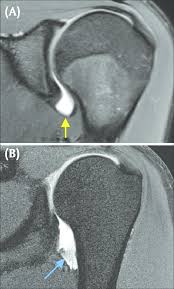 Hagl is an acronym for have a good life. Normal Ighl And Hagl Coronal Fat Saturated T1 Weighted Mr Download Scientific Diagram