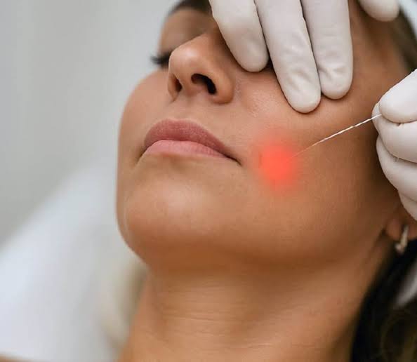 Endolift The Future of Non-Invasive Skin Rejuvenation