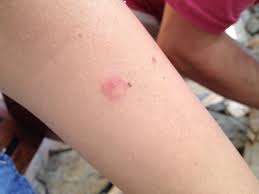 The science behind itchy bug bites. Bed Bug Bites Vs Mosquito Bites What S The Difference