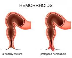 Image result for hemoroid human