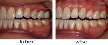 Real Patient Smile Gallery - Before And After Teeth Images