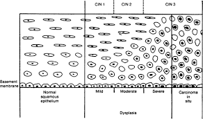 Treatment generally recommended for cin ii / cin iii or unspecified hsil, except during pregnancy. Cervical Intraepithelial Neoplasia History And Detection Glowm