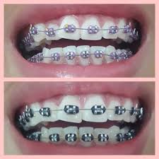 Black And White Braces For Teeth Above Is The Day I Got Ma Brace And Below Is My First Adjustment And Its Just Been 2 Months And I Can Al Cute Braces Colors Braces Bands Braces Teeth Colors