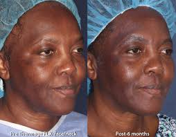 There are levels of selectivity. African American Skin Treatments San Diego Ca Clderm