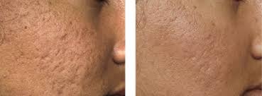 Maybe you would like to learn more about one of these? Mit Micro Needling Akne Und Aknenarben Bekampfen So Geht S